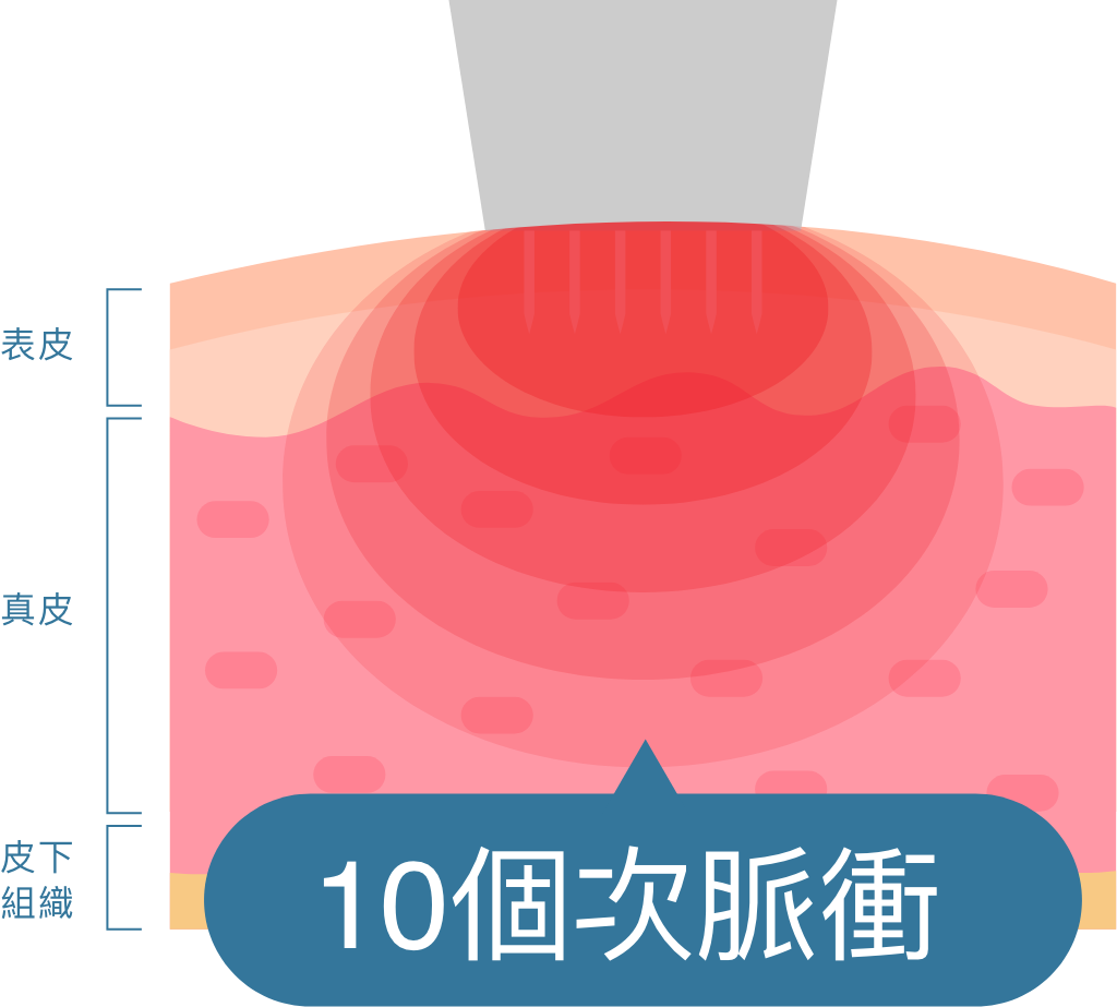 10個次脈衝